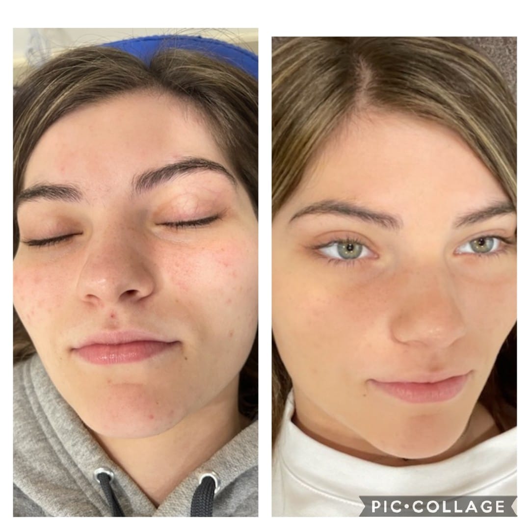 Acne Removal Cryo-Facial