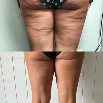 Cryo-slimming Thighs and Hips (Both Legs, Two Areas)